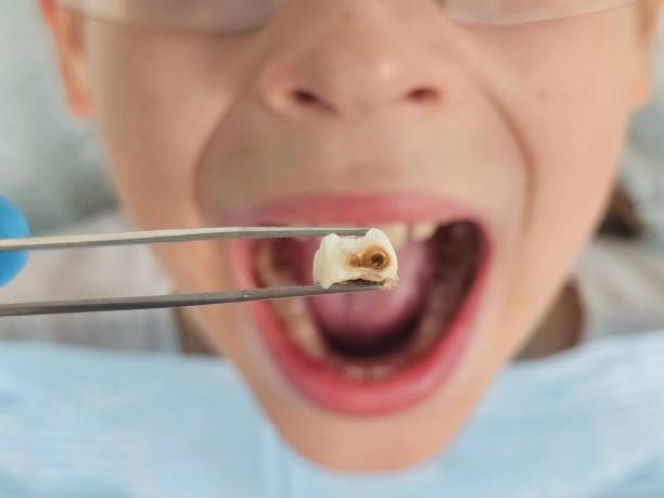 Best Broken or Cracked Tooth Emergency Dentist in Kempner, TX
